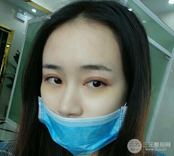 双眼皮7mm一年后照片
