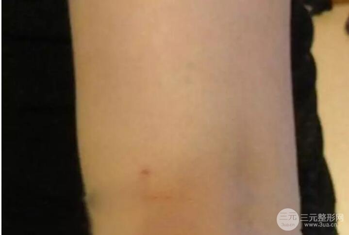 抽手臂脂肪的恢复过程