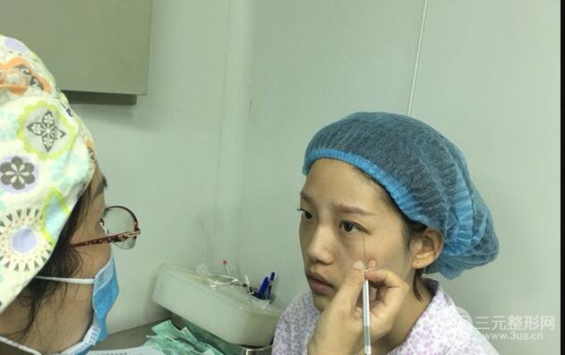 割双眼皮多久会恢复