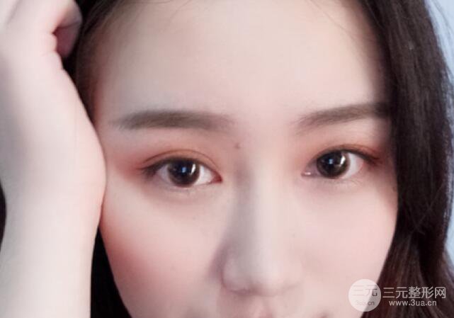 双眼皮7mm一年后照片