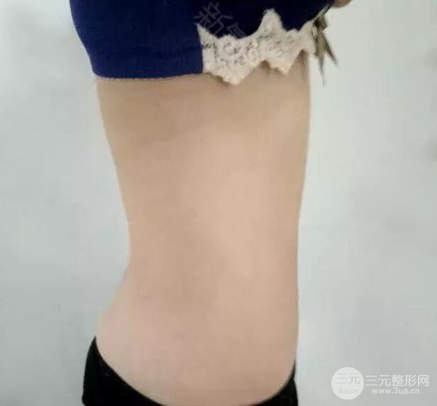 腹腰吸脂三个月图片