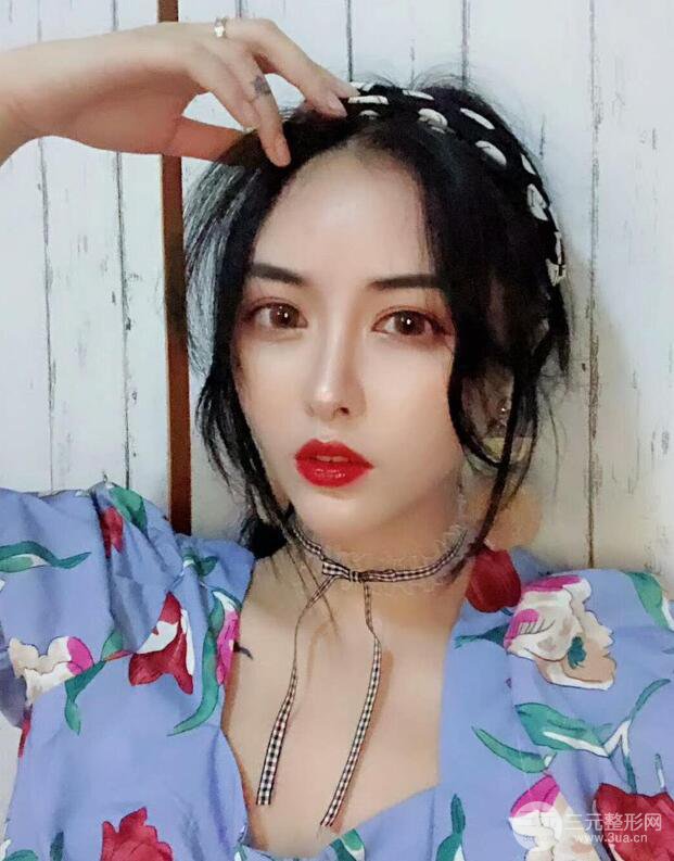 广州名韩医疗美容彭丽霞自体脂肪填充面部反馈