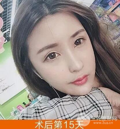 我的自体脂肪脸部填充日记