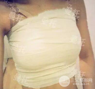 分享我的曼托隆胸图片