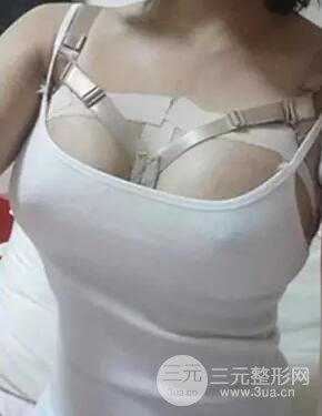 假体隆胸分享日记