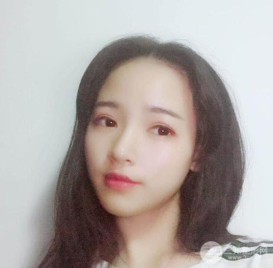 银川崔大夫博士丽医疗美容朱杰膨体隆鼻果反馈