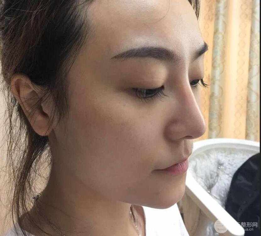 做了自体脂肪填充全脸，别人都以为我老公较为有钱