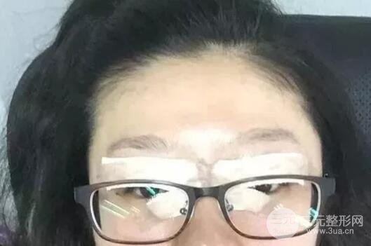 双眼皮手术后恢复期记录