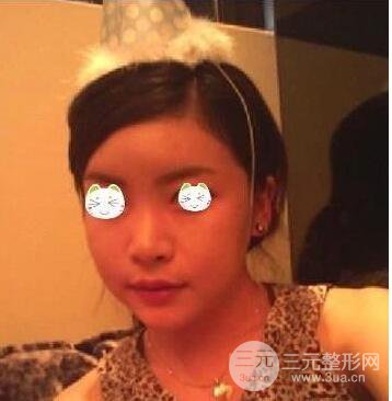 谈一谈我的磨骨瘦脸经历