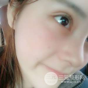网红鼻整形三十天恢复记录