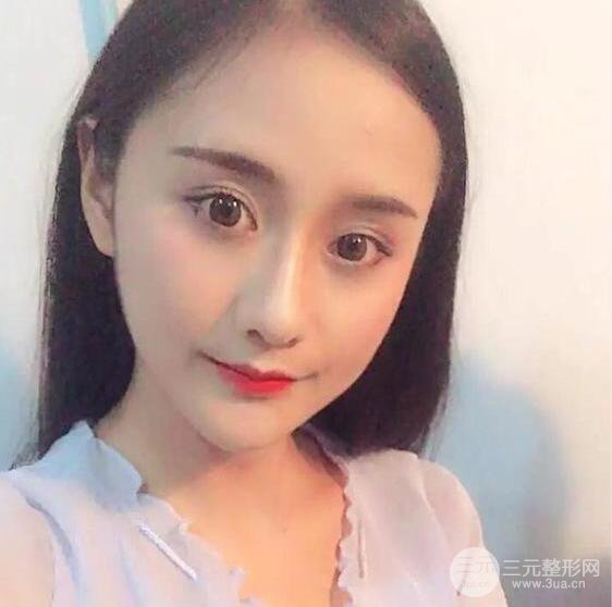 威高梨花医疗美容金成镐全切双眼皮+开眼角术后恢复记录