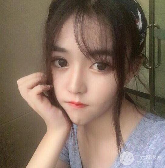 泉州亿星医疗美容闵英俊切开双眼皮果对比