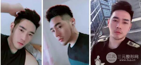 硅胶隆鼻一至7天恢复图