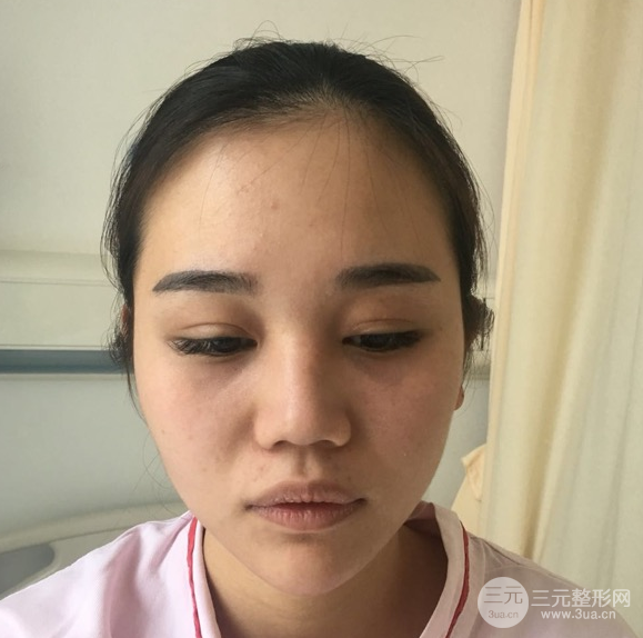 隆鼻整形30天恢复全记录附图片