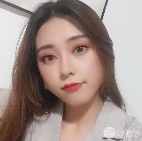 东莞君熠医疗美容李陵峰自体脂肪全脸填充恢复记录