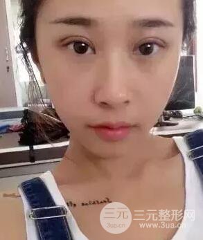 切开双眼皮15天果图