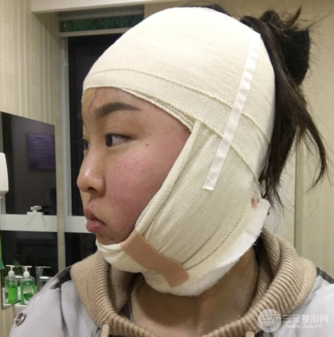 面部光纤溶脂三个月恢复记录，妹子终于摆脱大脸盘子辣