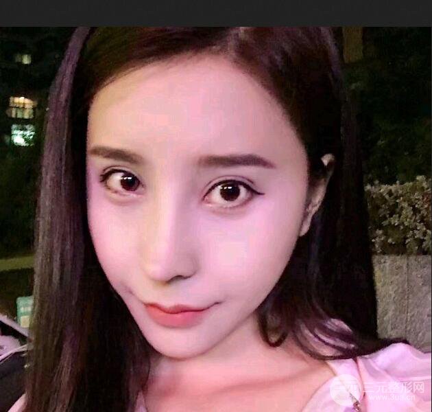 青岛海伦整形朱洪涛肋软骨隆鼻恢复记录