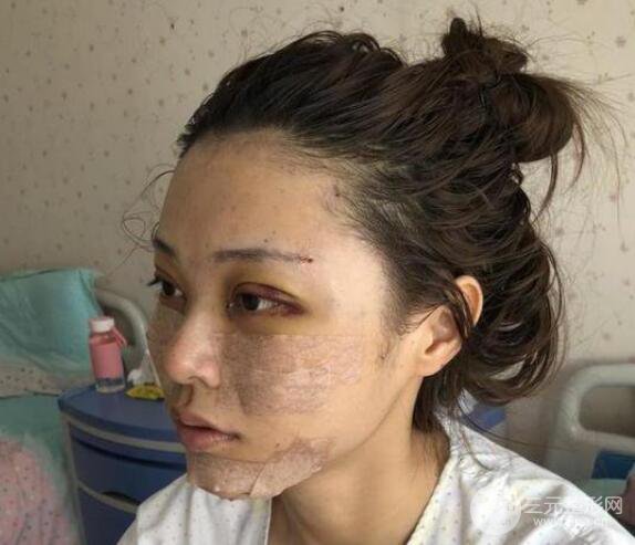 分享一波我的自体脂肪填充面部恢复记录