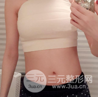 自体脂肪隆胸恢复图曝光，见证从A到C的蜕变