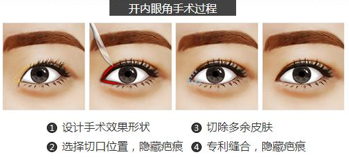 开内眼角手术过程，开眼角有哪些方式，开眼角多少钱？
