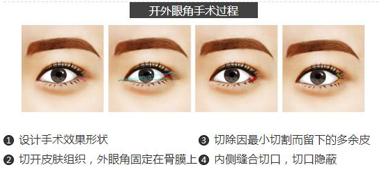 开外眼角手术过程，开眼角需要多少钱，开眼角有哪些有点