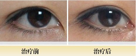 开眼角对比图，哪些眼睛适合开眼角