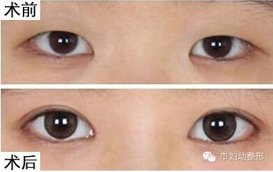  开眼角前后对比图，开眼角手术