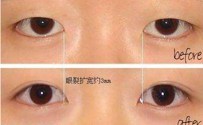 开眼角会留疤吗，开眼角前后对比图，开眼角多少钱
