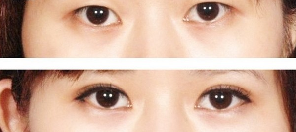 双眼皮整形前后对比图,上海美之源整形外科医院整形价格表