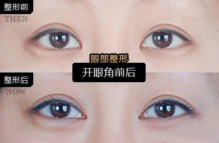 开眼角对比图,开眼角多少钱