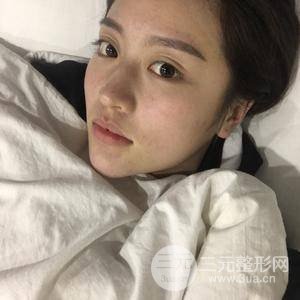 面部吸脂100天恢复果对比图