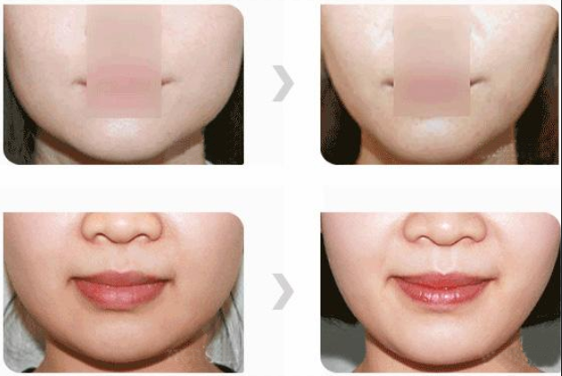 磨腮削骨整形前后对比图,上海华美整形价格表