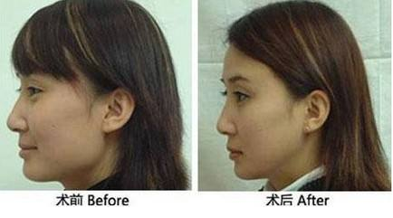 下颌角磨骨手术多少钱，前后对比图