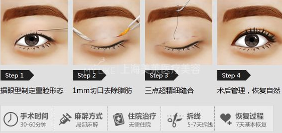 上海割双眼皮多少钱？双眼皮多少钱