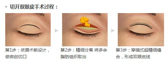 上海割双眼皮多少钱？全切双眼皮多少钱