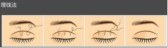 上海割双眼皮多少钱？埋线双眼皮价格多少