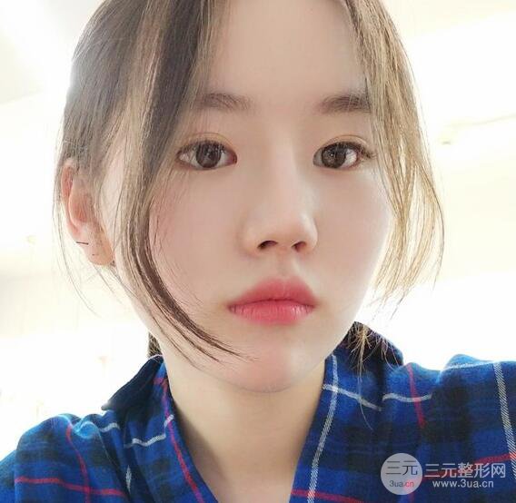 上海华美医疗美容李庭勋膨体隆鼻怎么样？果对比图