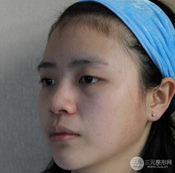 深圳恩吉娜做切开双眼皮多久恢复啊