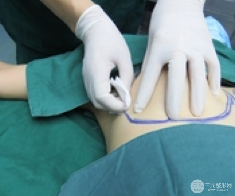 自体脂肪隆胸恢复图曝光，见证从A到C的蜕变