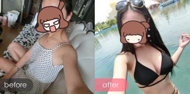 隆胸整形手术前后对比照片,上海美之源整形外科医院整形价格表