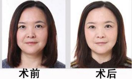 皮肤紧致手术前后对比图