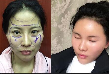 自体脂肪填充面部前后对比图,自体脂肪填充太阳穴,额头