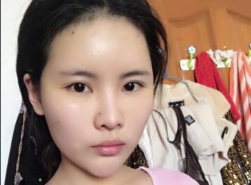 不错,已经消肿得差不多了,终于体会到了做女神的快乐,老公也说很漂亮