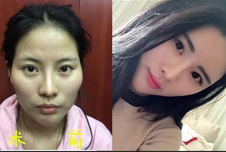 三元整形网 案例     术后40天:现在脸部很自然,饱满,整个人都变得
