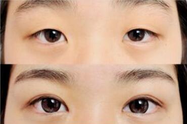 三点定位双眼皮和全切、埋线有什么区别?哪种方法自然？