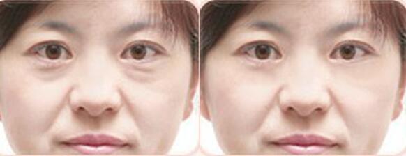 整形手术祛眼袋