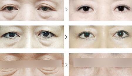 上海祛眼袋手术多少钱|全新价格表,祛眼袋手术前后对比图