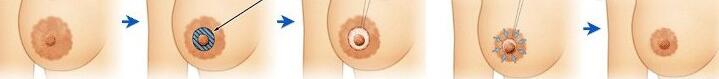乳晕缩小原理图，上海乳头乳晕缩小多少钱？