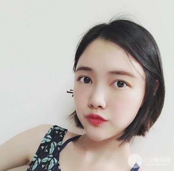 上海华美李健自体脂肪详细部填充果图，少女脸经久不衰的秘密在这里